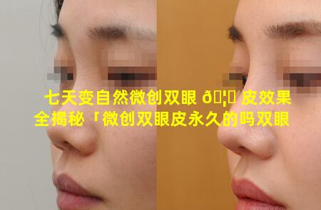 七天变自然微创双眼 🦉 皮效果全揭秘「微创双眼皮永久的吗双眼皮多久恢复」